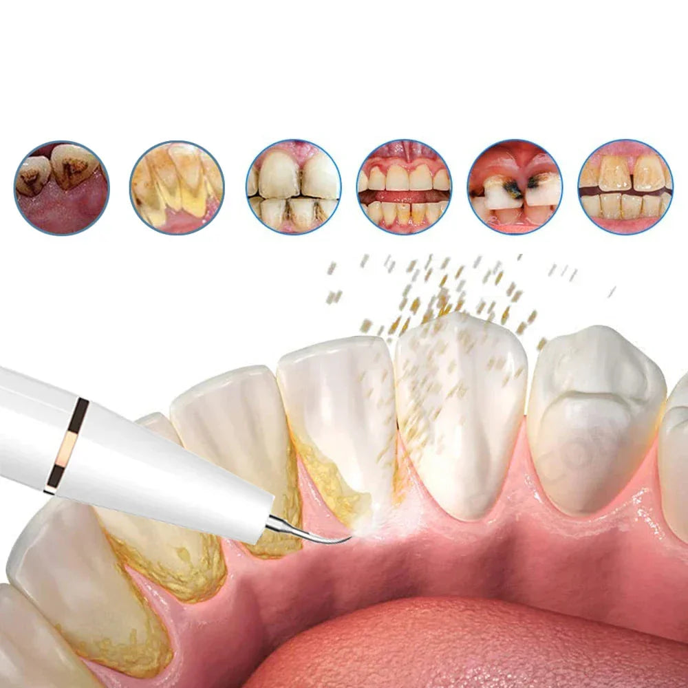FreshSmile Ultrasonic Tooth Cleaner – For Clean and Healthy Teeth