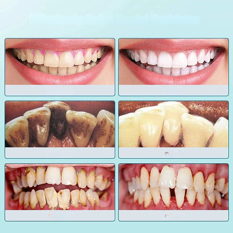 FreshSmile Ultrasonic Tooth Cleaner – For Clean and Healthy Teeth