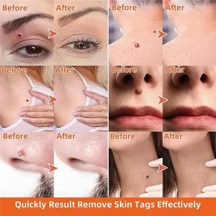 Painless Skin Tag Remover – Safe and Easy for Home Use