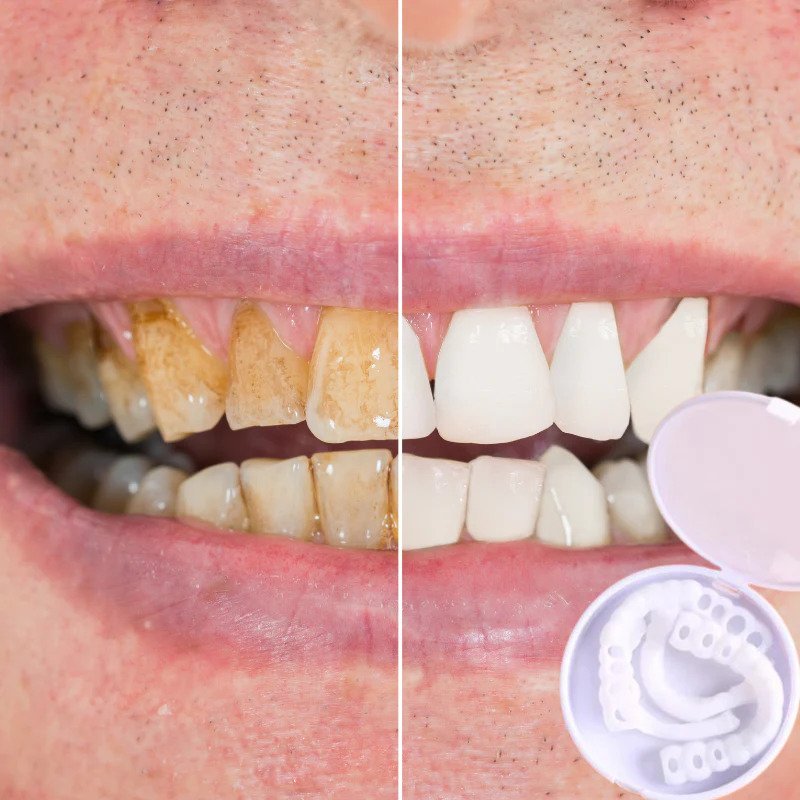 BrightSmile Whitening Kit – Radiant and Confident