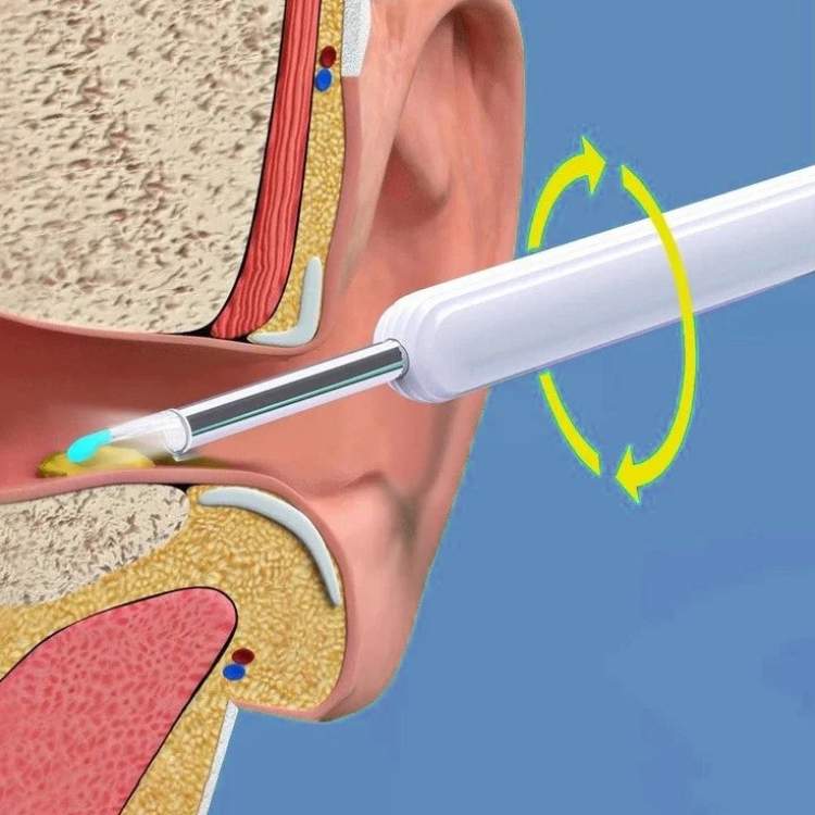 ClearView Ear Cleaner – Smart, Safe and Hygienic